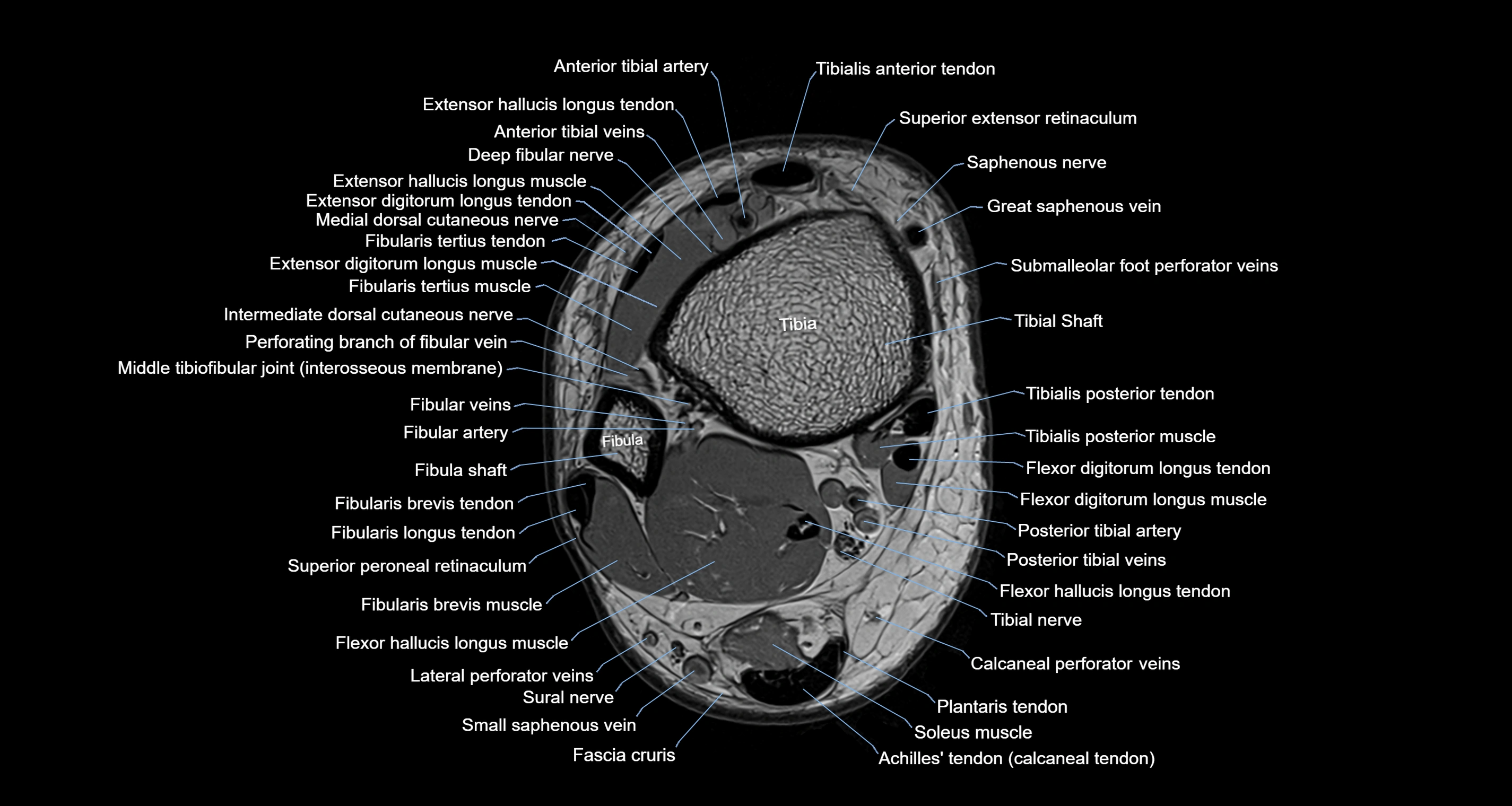 Ankle axial anatomy 3T MRI images -img-10001-00003.webp